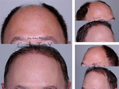 About New York Hair Restoration .